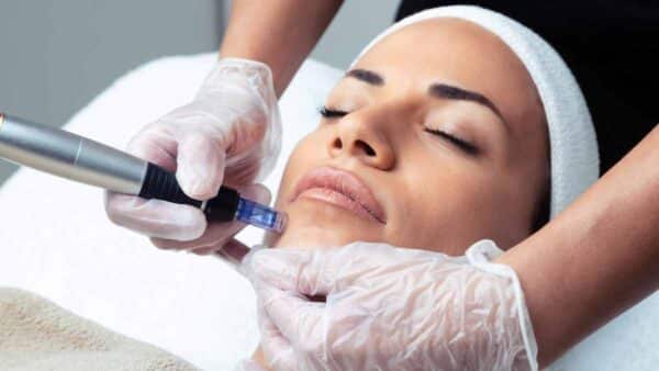 Microneedling